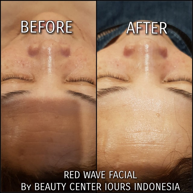 Beauty Treatment